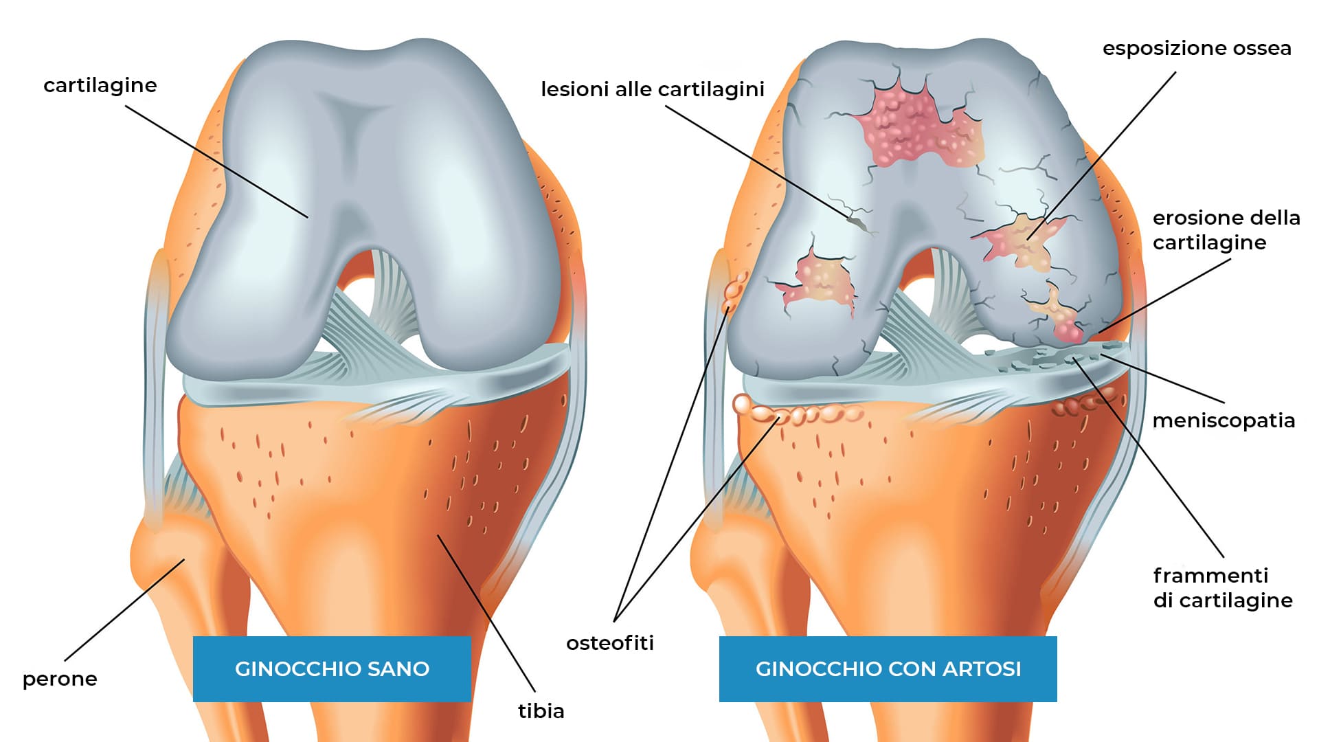 artrosi del ginocchio fisioterapia