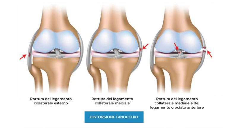 Distorsione del ginocchio